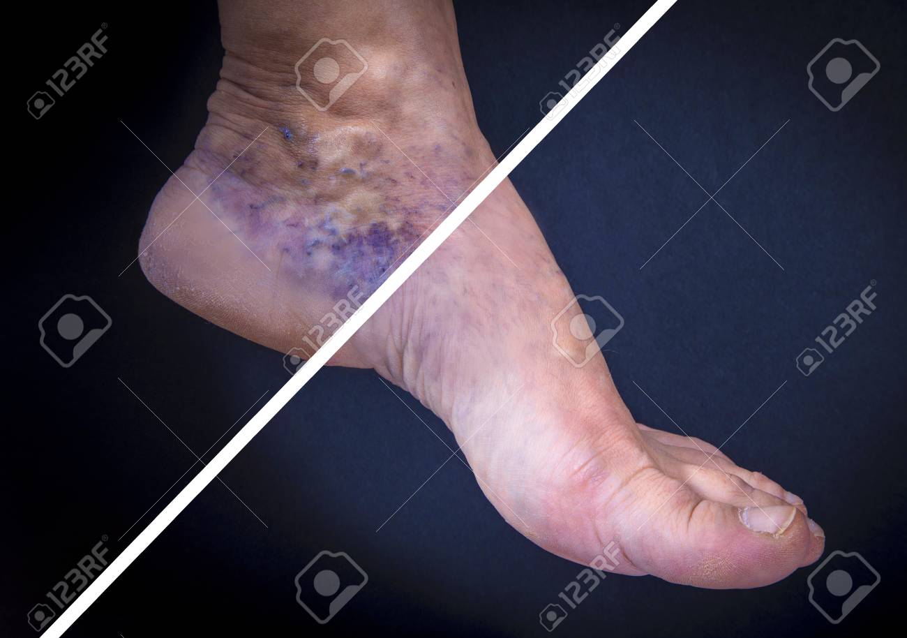varicose foot pictures fotografie