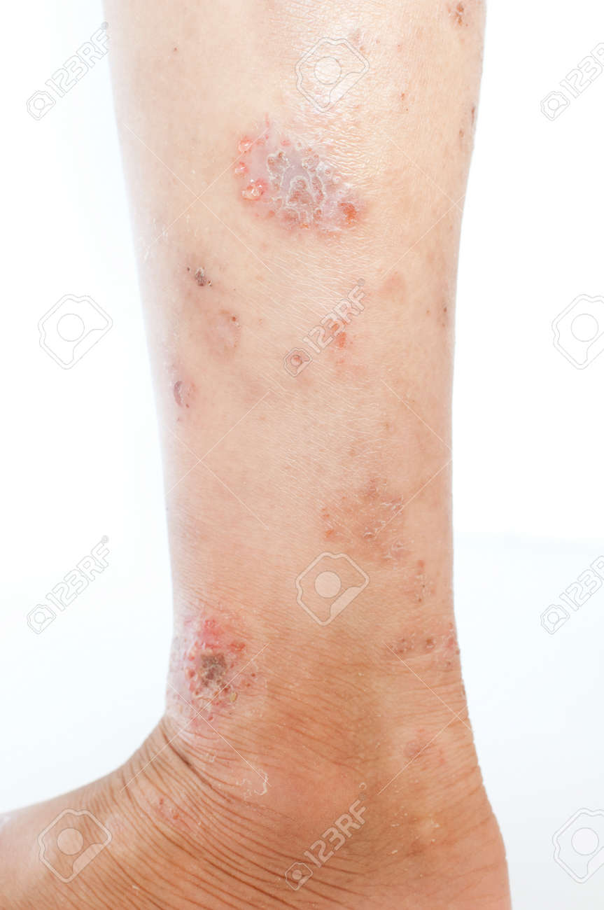 Eczema Rash Wound On Kid S Calf Stock Photo Picture And Royalty Free Image Image
