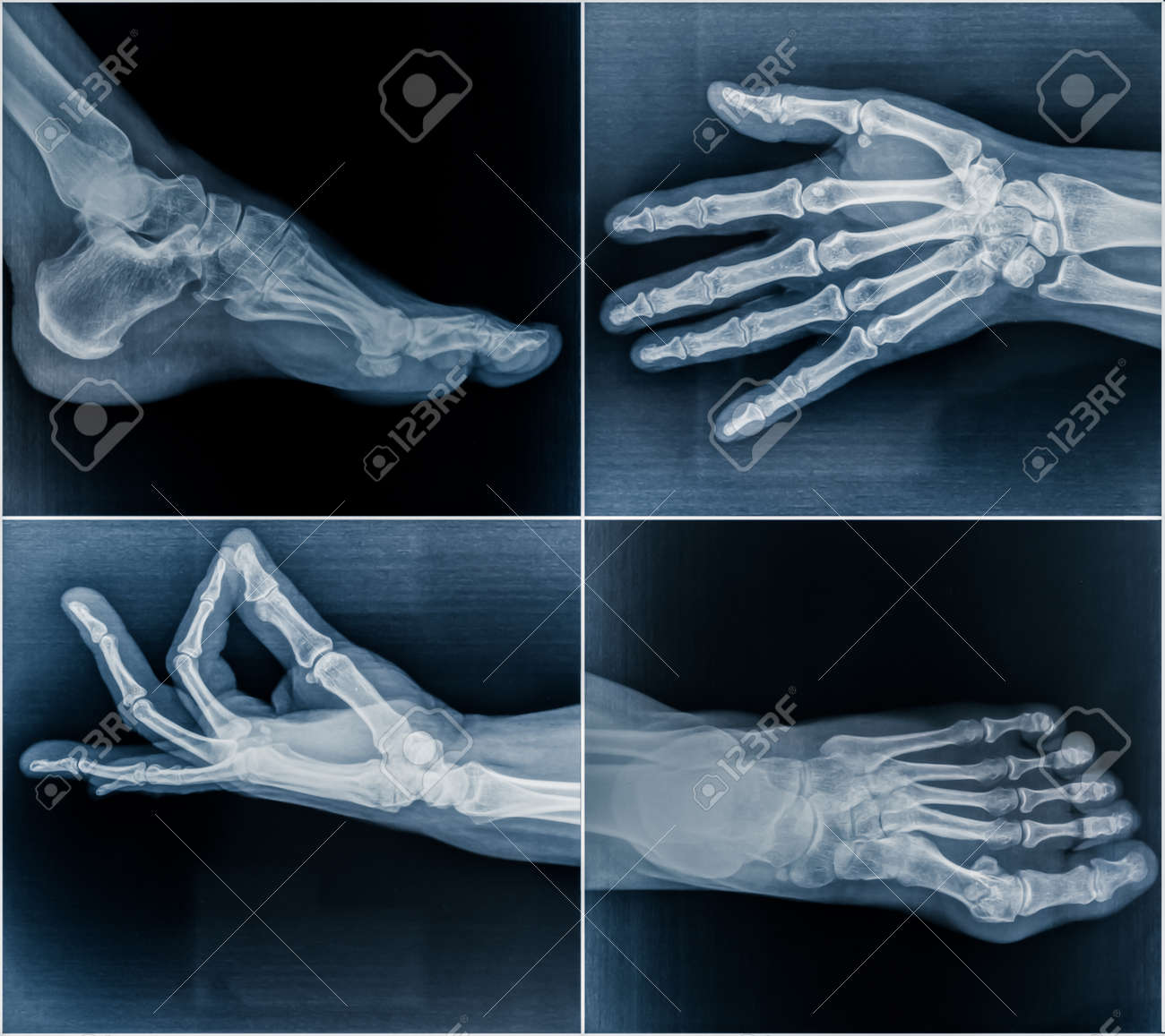 50 year old woman's x-ray scans from hands and feet - 51679855 50 year old woman's x-ray scans from hands and feet - 51679855