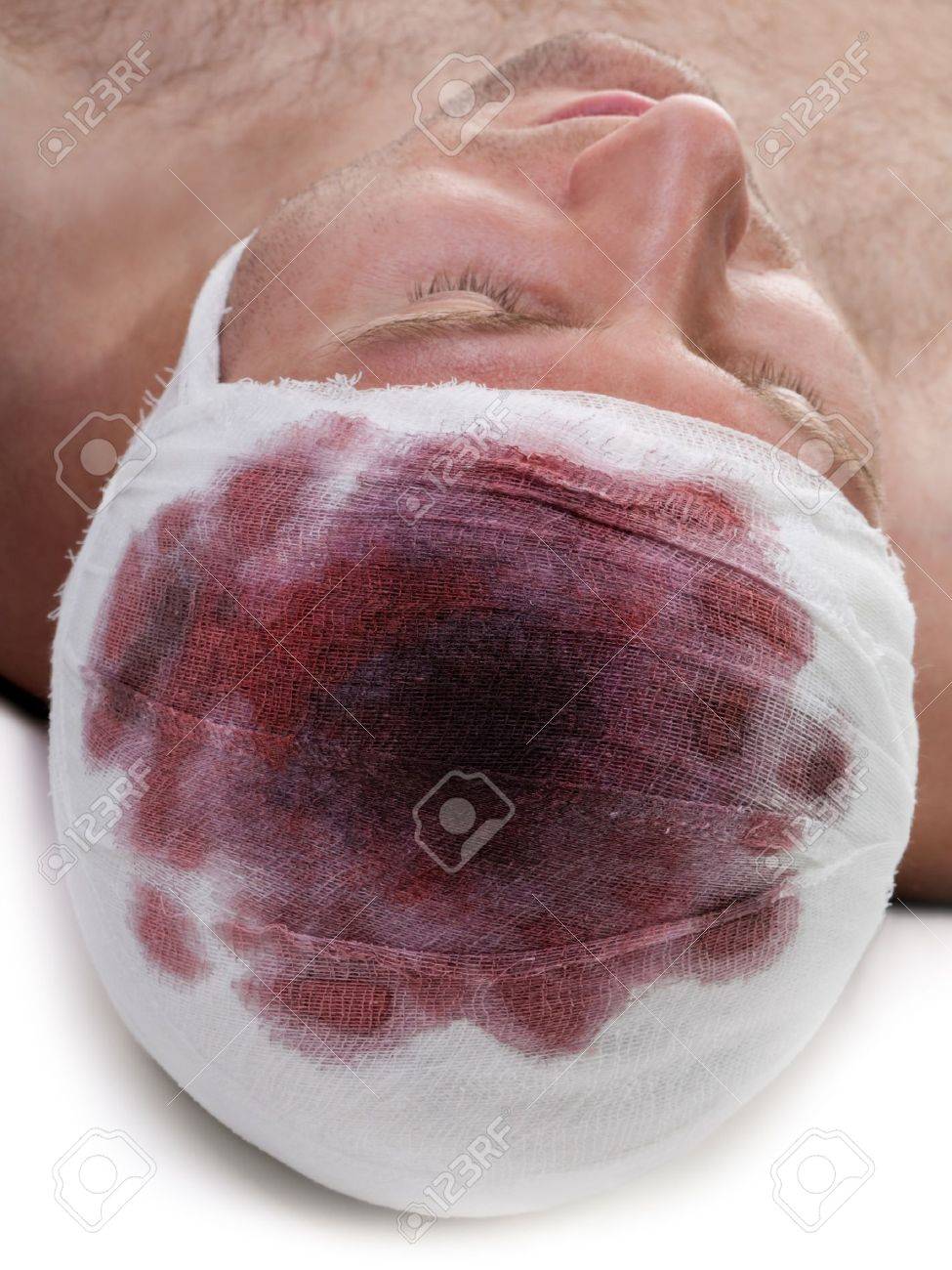 Conmoción cerebral nariz de sangre