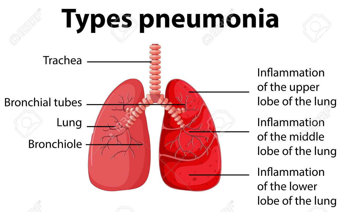 pneumonia patient diagram wiring diagrams