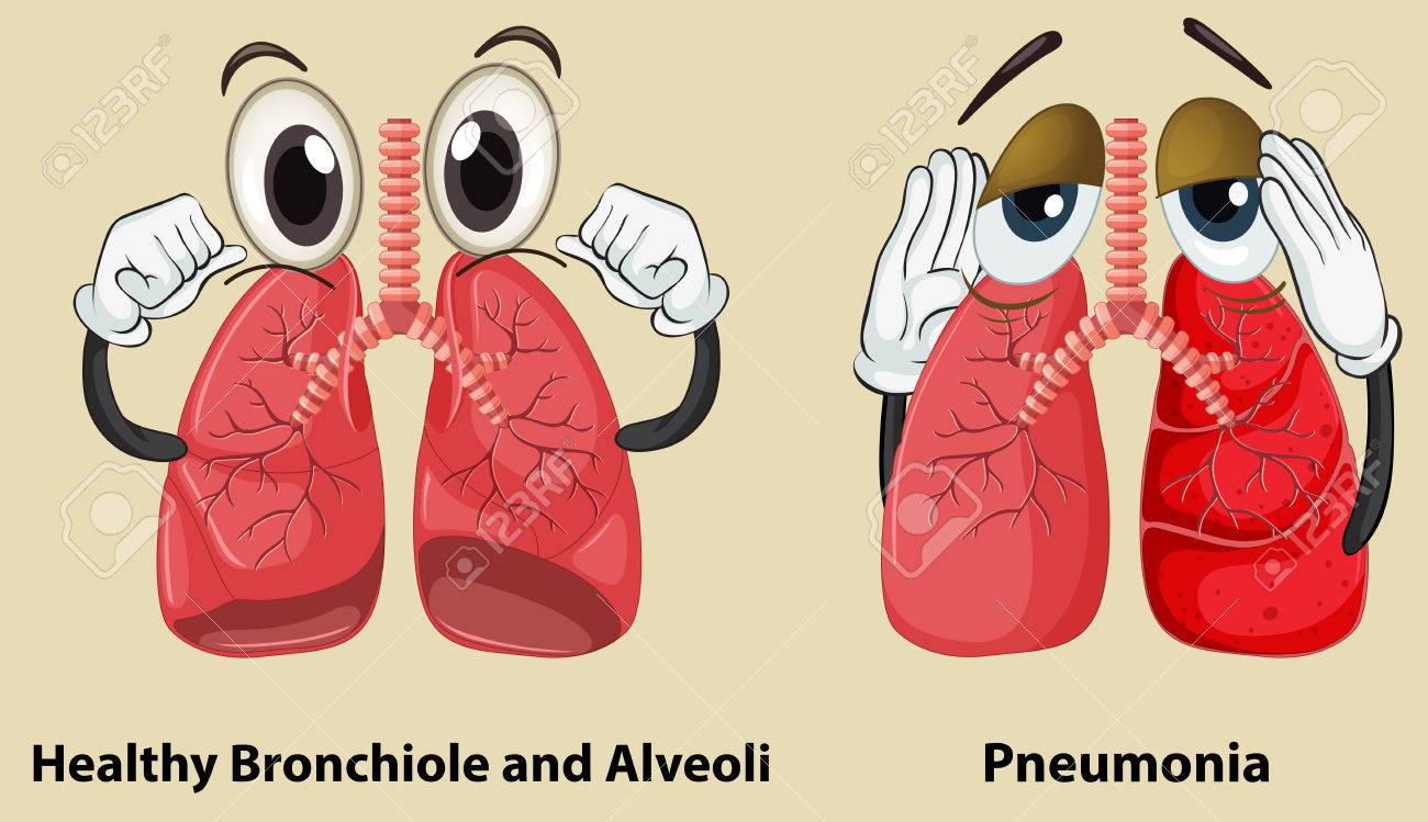 diagram showing healthy and pneumonia lungs illustration royalty