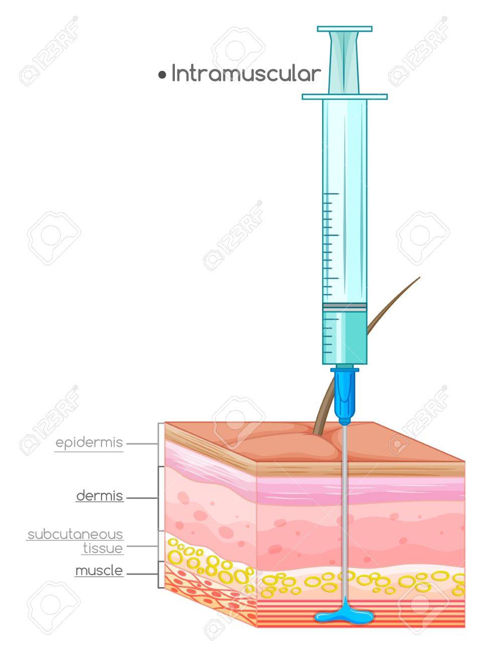 diagram showing intramuscular injection illustration royalty free