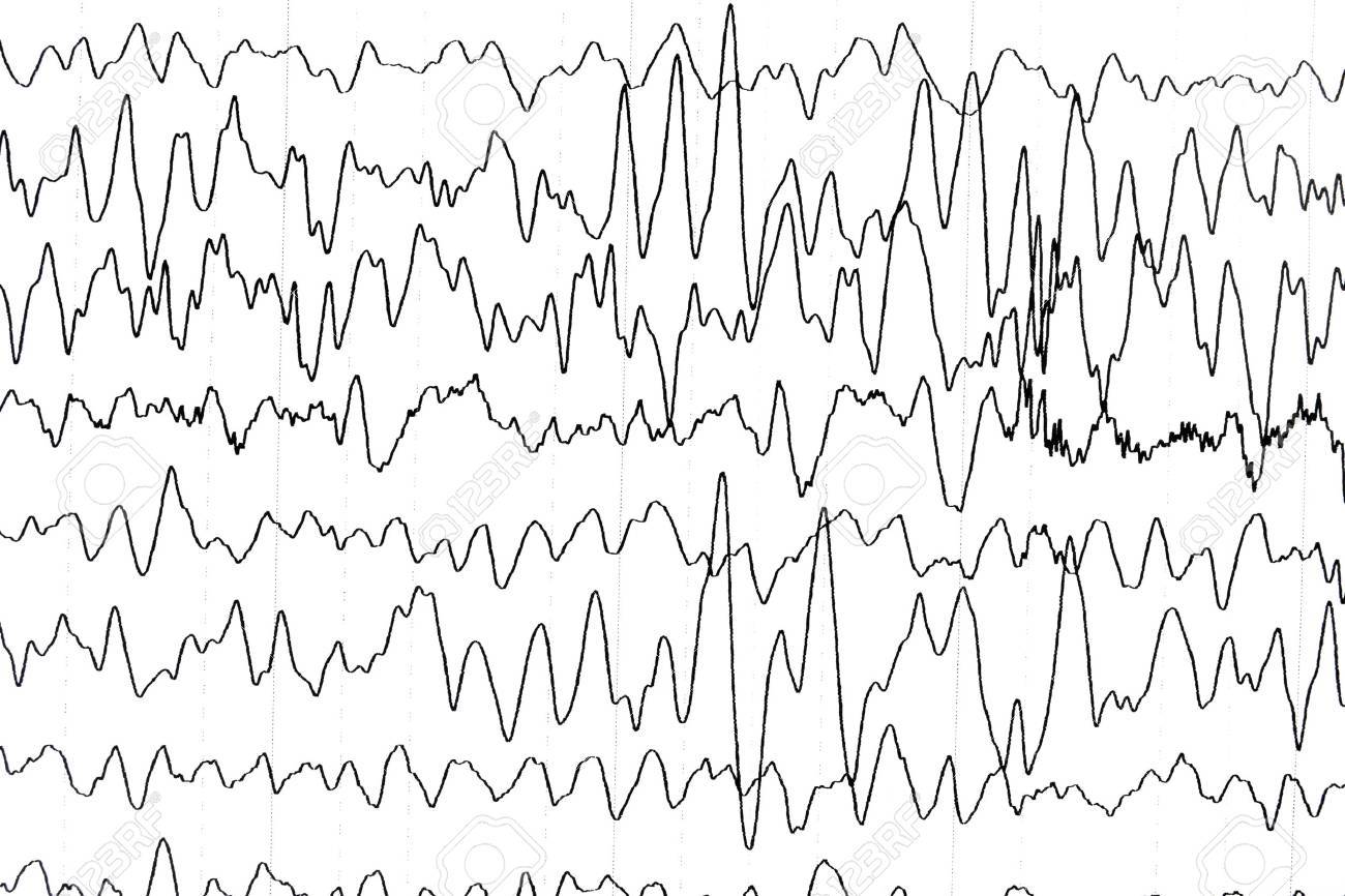 electroencephalography test that shows electrical activity of electroencephalography