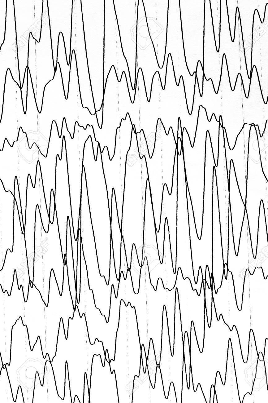 electroencephalography test that shows electrical activity of electroencephalography