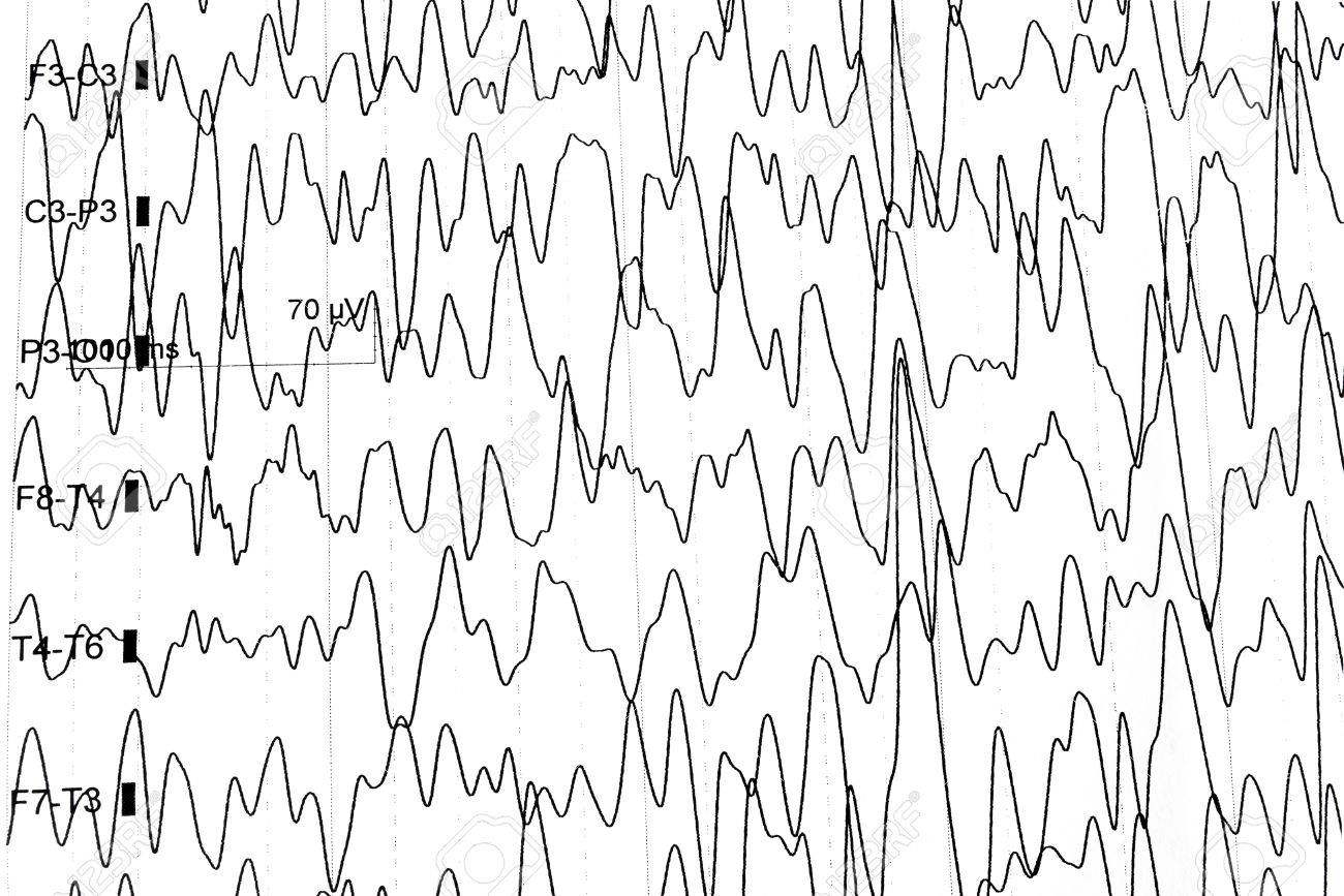 electroencephalography test that shows electrical activity of electroencephalography