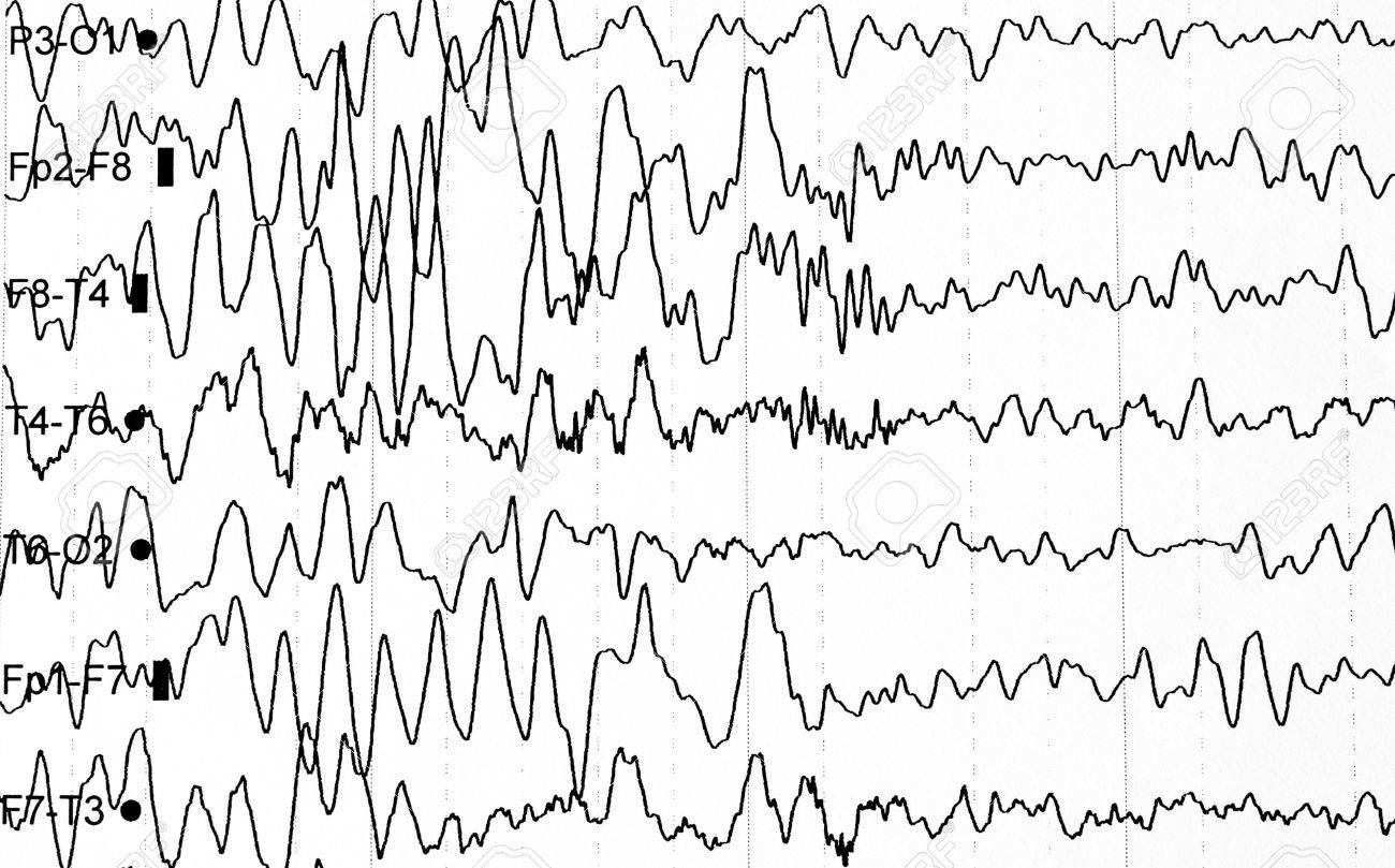 electroencephalography test that shows electrical activity of electroencephalography