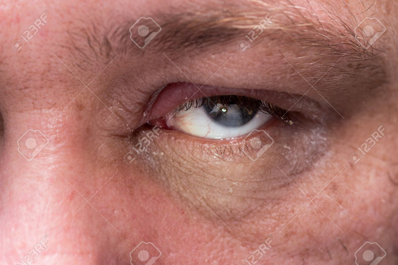 Gros Plan De L Infection Des Yeux Avec Des Paupieres Gonflees Banque D Images Et Photos Libres De Droits Image
