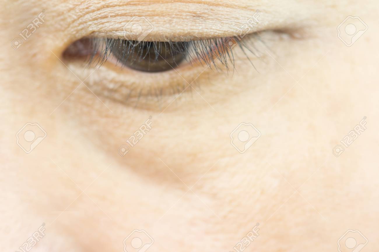 bags wrinkles under eyes