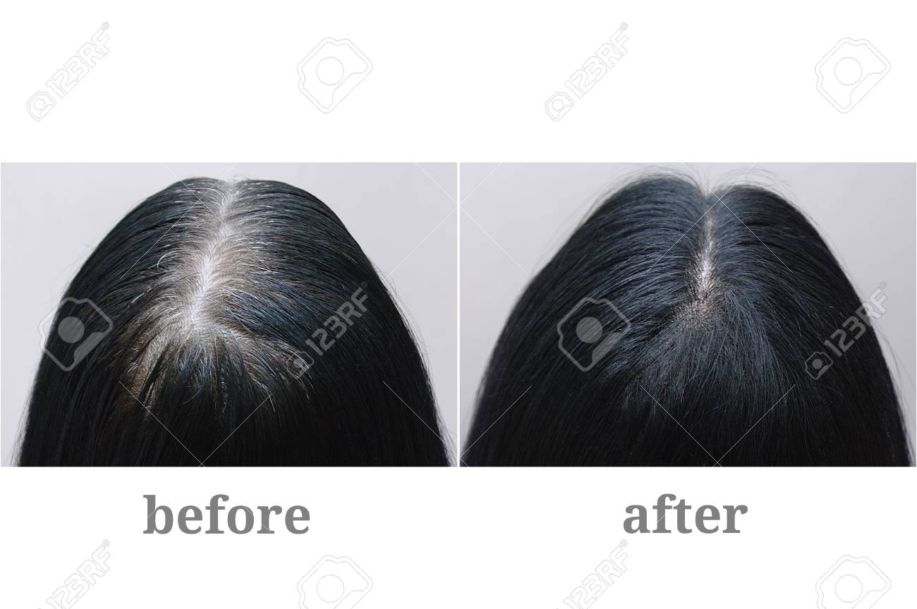 Head of a girl with black gray hair. Hair coloring.Top of the head. Before and after. - 126957741 Head of a girl with black gray hair. Hair coloring.Top of the head. Before and after. - 126957741