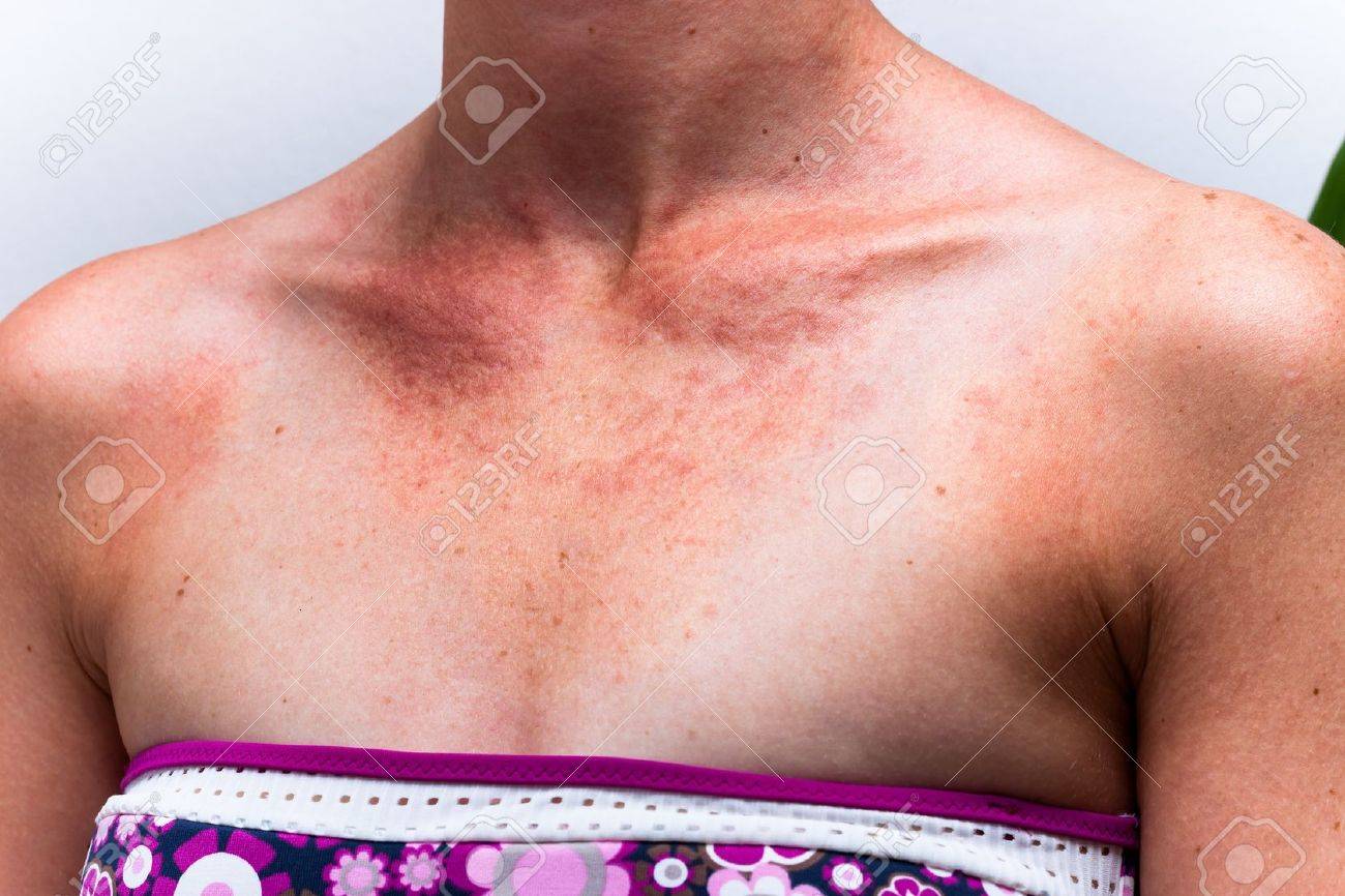 Detail of female sunburnt skin chest with allergic reaction. - 17134194 Detail of female sunburnt skin chest with allergic reaction. - 17134194