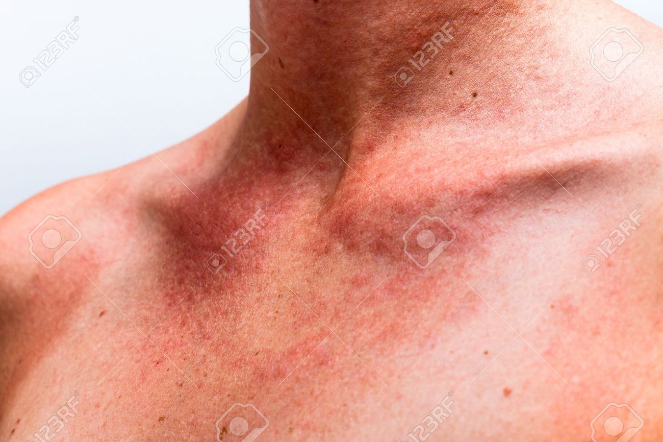 Close up of female sunburnt skin neck with allergic reaction. - 17133809 Close up of female sunburnt skin neck with allergic reaction. - 17133809