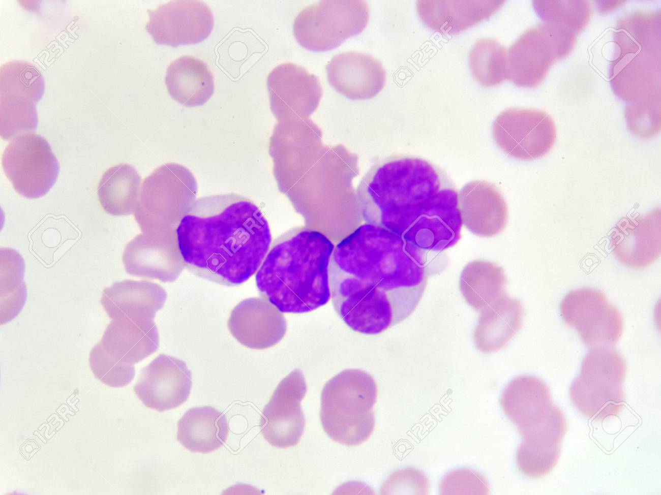 急性骨髄性白血病の血液像 の写真素材 画像素材 Image 87172720