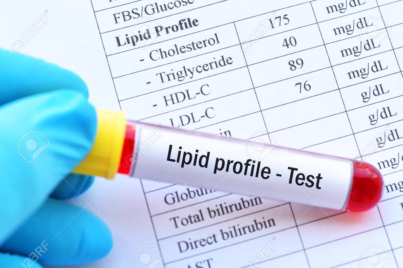 What are the test under lipid profile? What are the test under lipid profile?