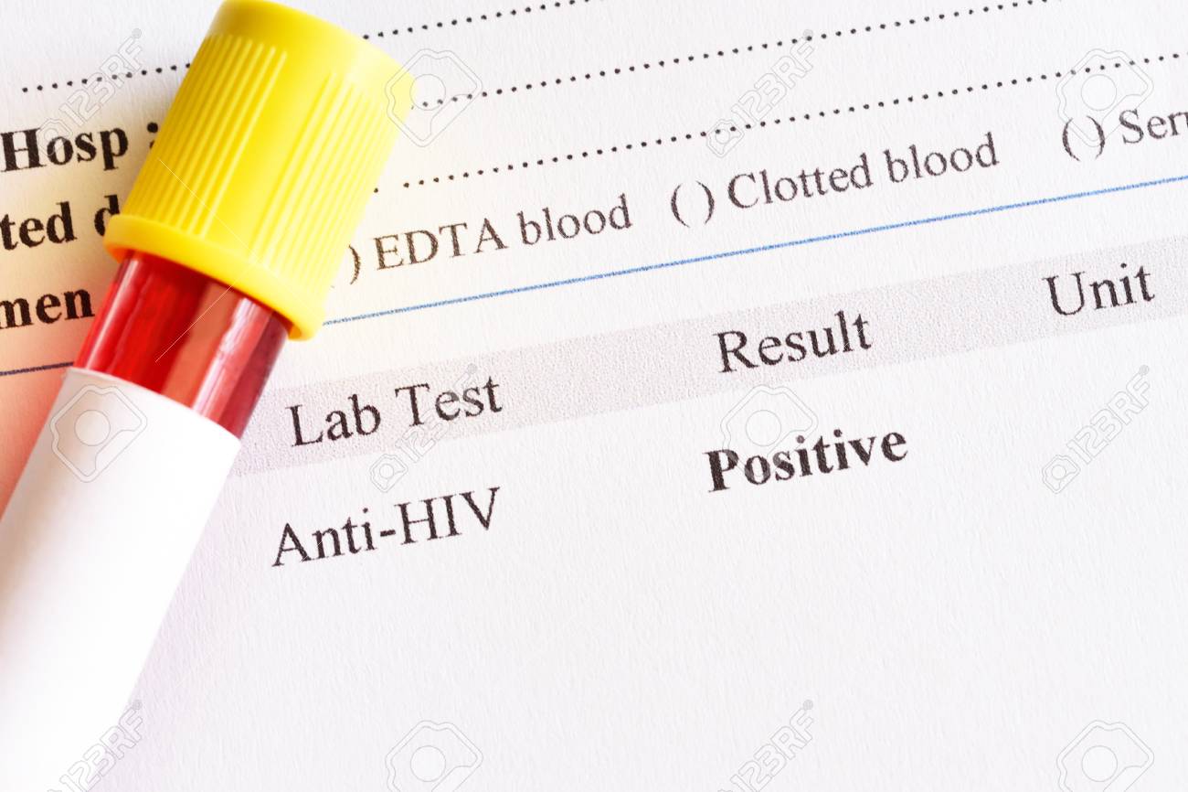 Hiv Positive Test Result With Blood Sample Tube Stock Photo Picture And Royalty Free Image Image Hiv Positive Test Result With Blood Sample Tube Stock Photo Picture And Royalty Free Image Image
