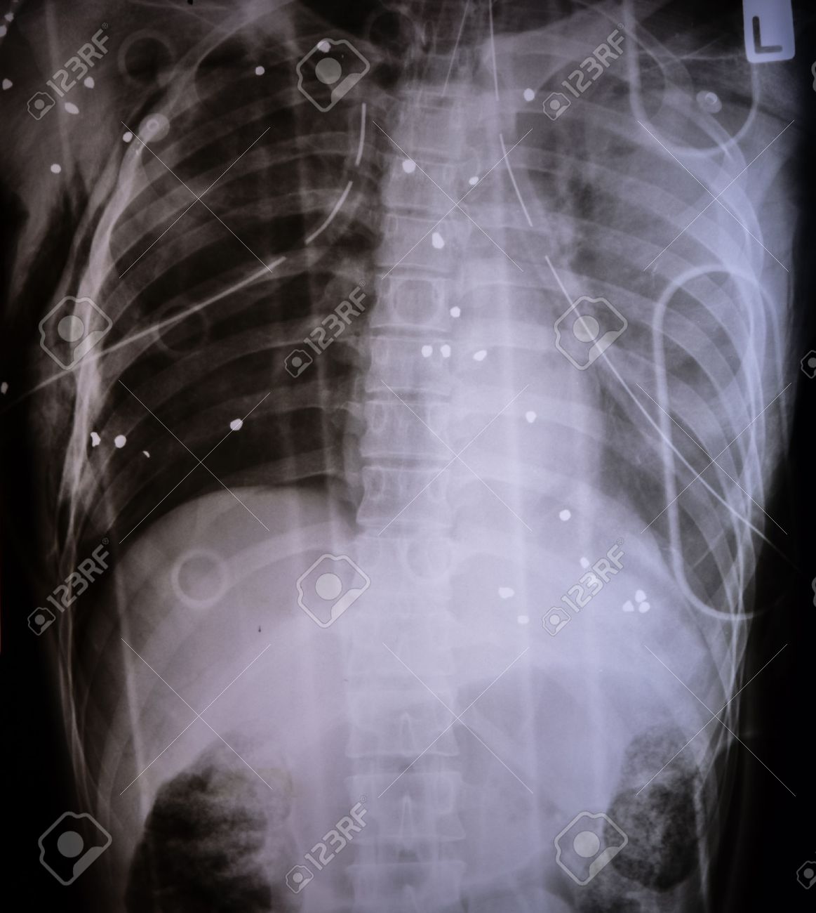 X Ray Image Of A Bullet From Gun In Chest Stock Photo, Picture and Royalty  Free Image. Image 32552460.