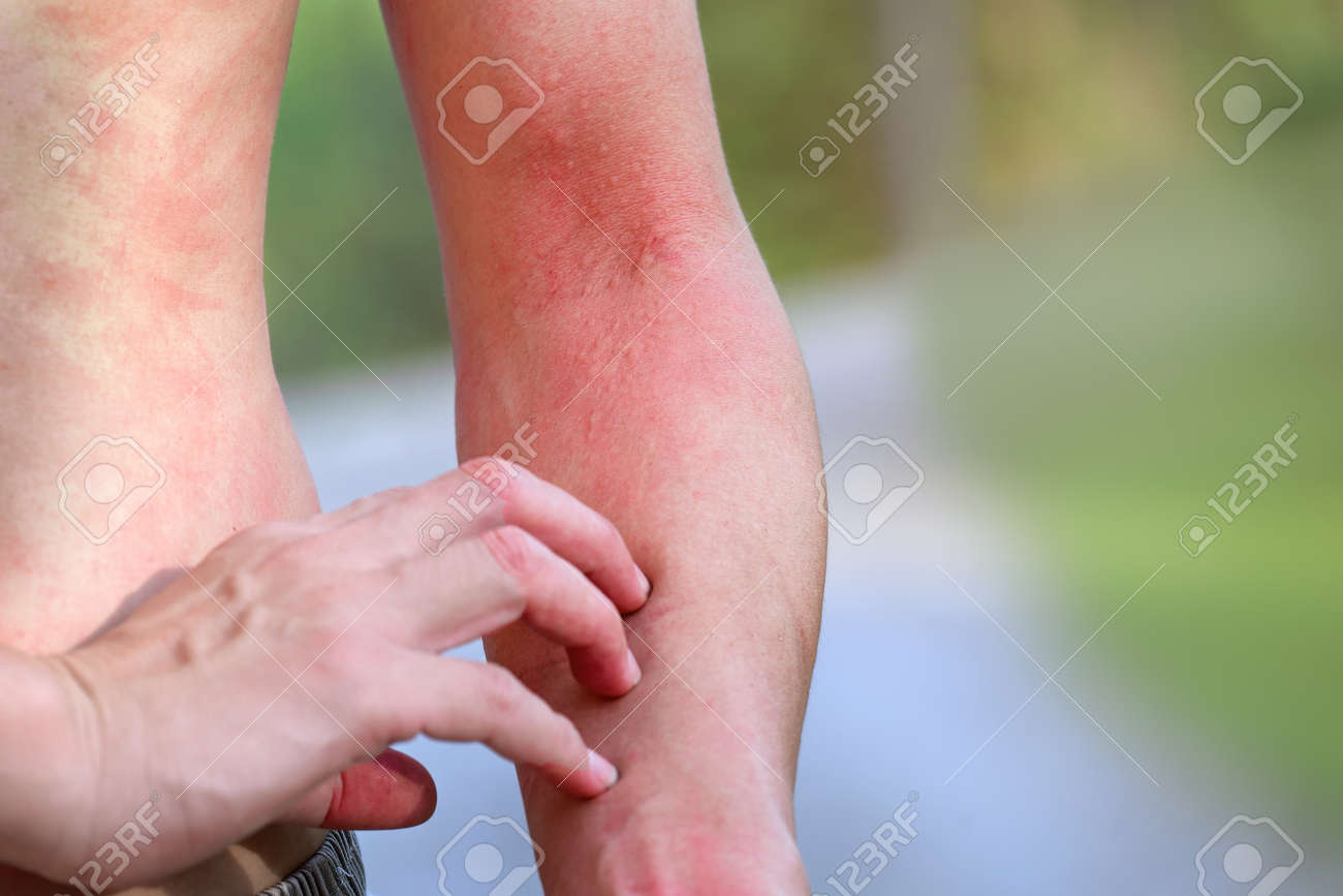 https://previews.123rf.com/images/jes2ufoto/jes2ufoto2204/jes2ufoto220400009/185030832-man-suffering-from-itching-on-arm-skin-body-and-scratching-an-itchy-place-allergic-reaction-to.jpg