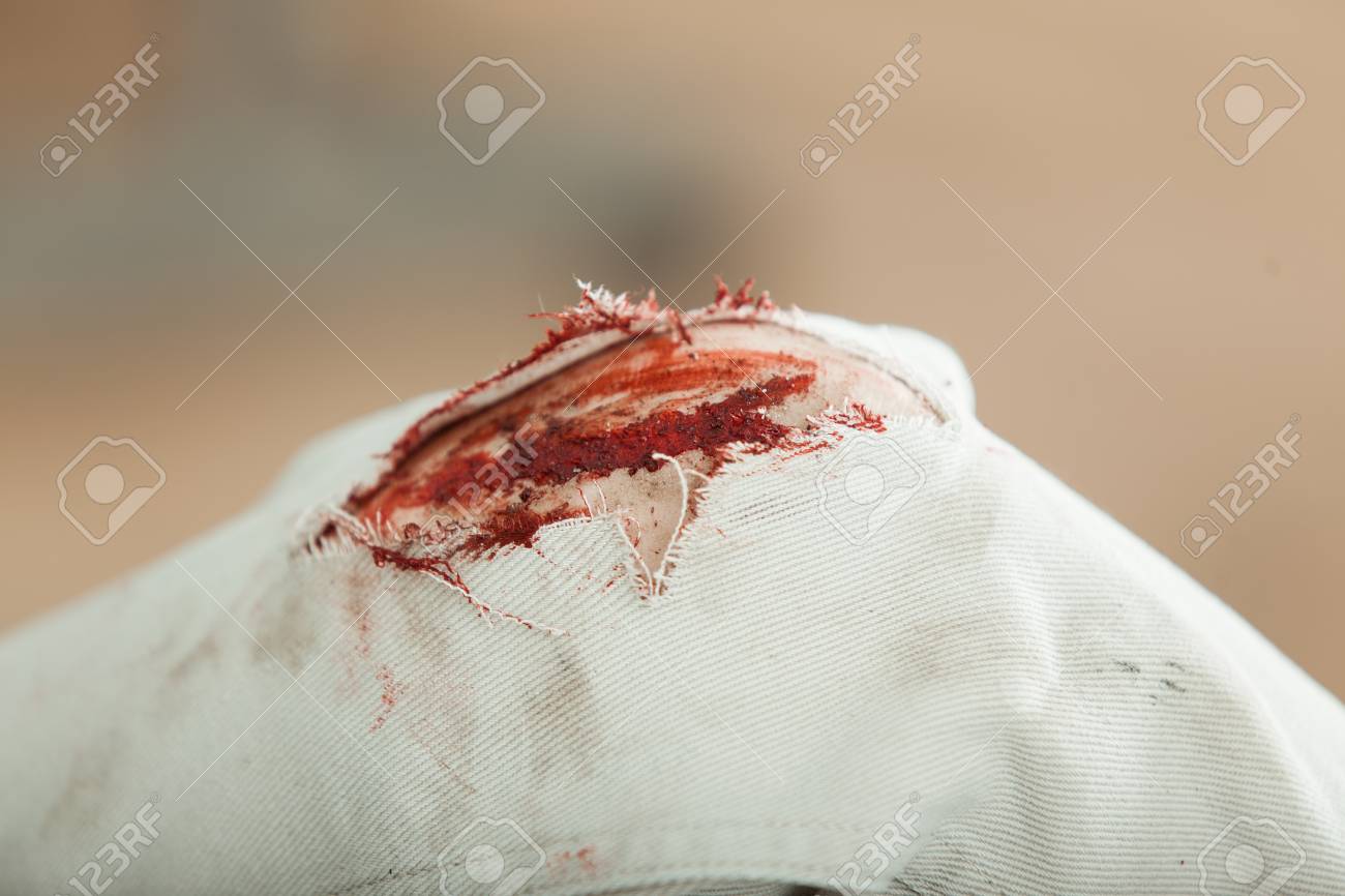 Cerrar La Vista De La Sangrienta Rodilla Herida De Un Hombre Joven