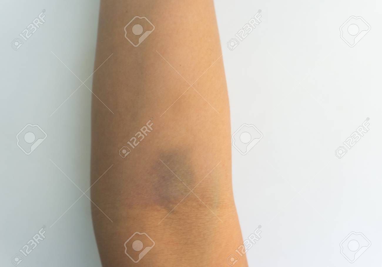 腕にあざ の写真素材 画像素材 Image