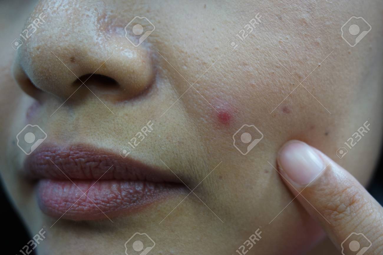 にきび 鼻 頬 顎から問題の皮膚と Yaoung 女性 の写真素材 画像素材 Image 3941