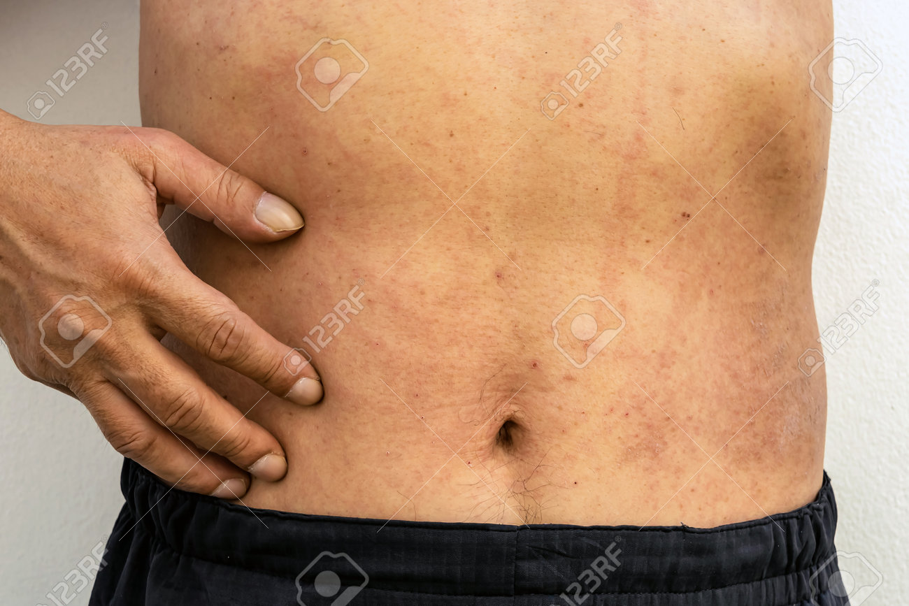 11 Common Rashes on Kids and Preschoolers (With Images) - GoodRx, image size:1300x867