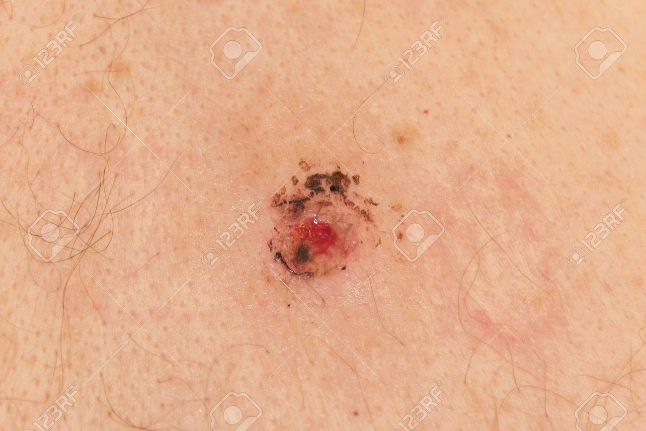 How to Undergo a Mole Biopsy pics How to Undergo a Mole Biopsy picture