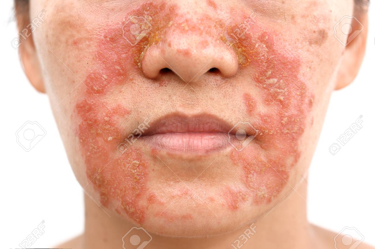 Seborrheic Dermatitis In Adult Face Isolated White Background Stock Photo Picture And Royalty Free Image Image
