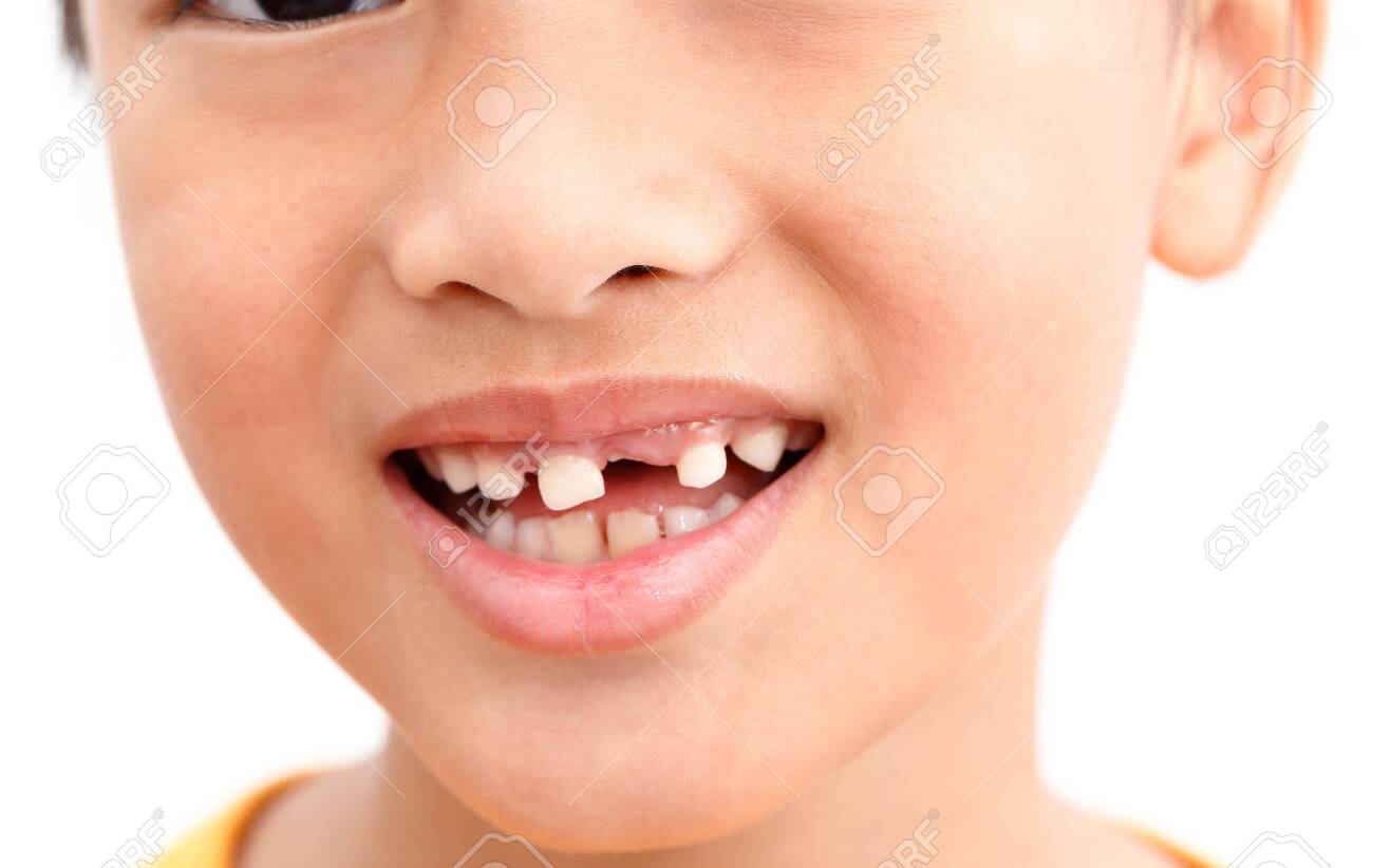 Little girl Show Broken tooth with smile. Isolated on white background - 122196280 Little girl Show Broken tooth with smile. Isolated on white background - 122196280