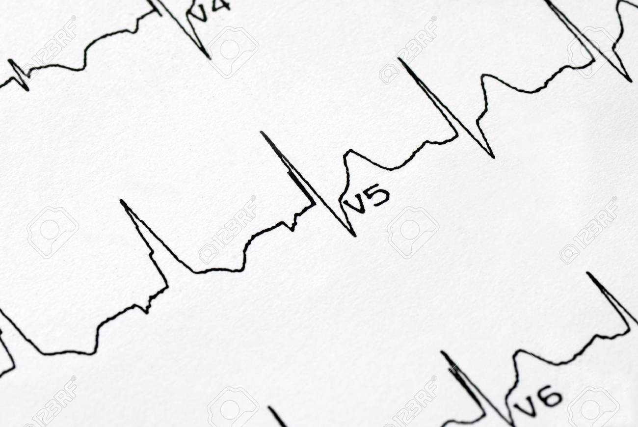 Ekg Chart