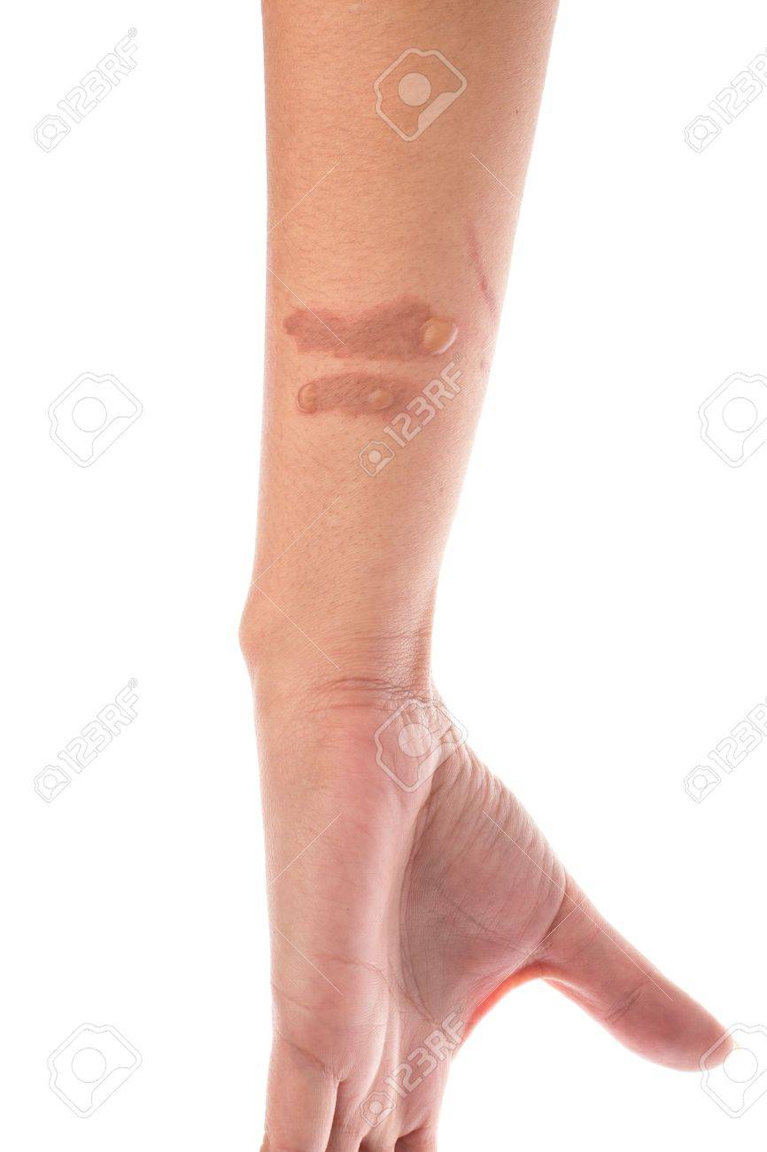Brûlure Au Deuxième Degré De Brûlure Sur L'avant-Bras Blister Banque  D'images Et Photos Libres De Droits. Image 17806959.