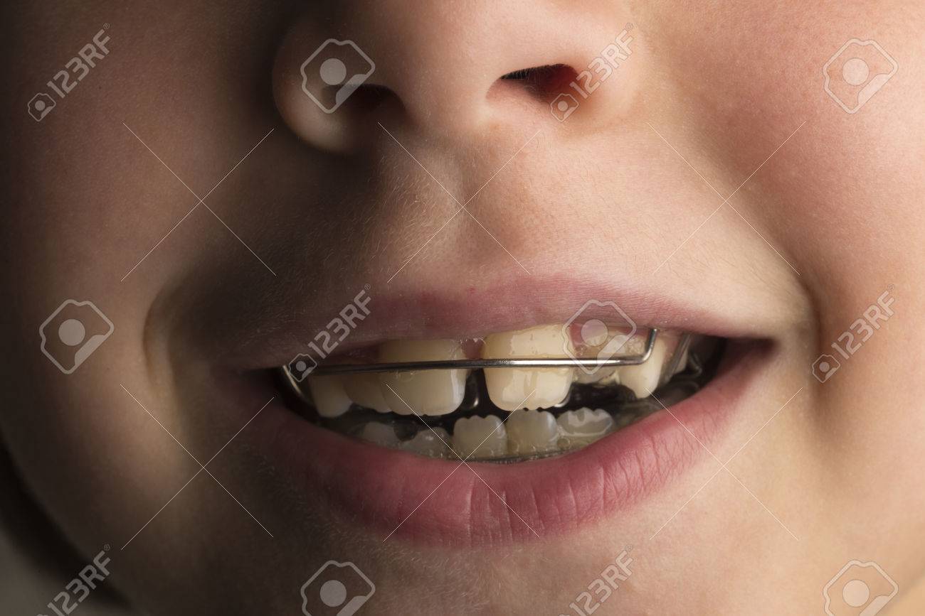 Closeup of smiling little girl wearing an orthodontic dental apparatus for correcting the position of teeth - 64643848 Closeup of smiling little girl wearing an orthodontic dental apparatus for correcting the position of teeth - 64643848