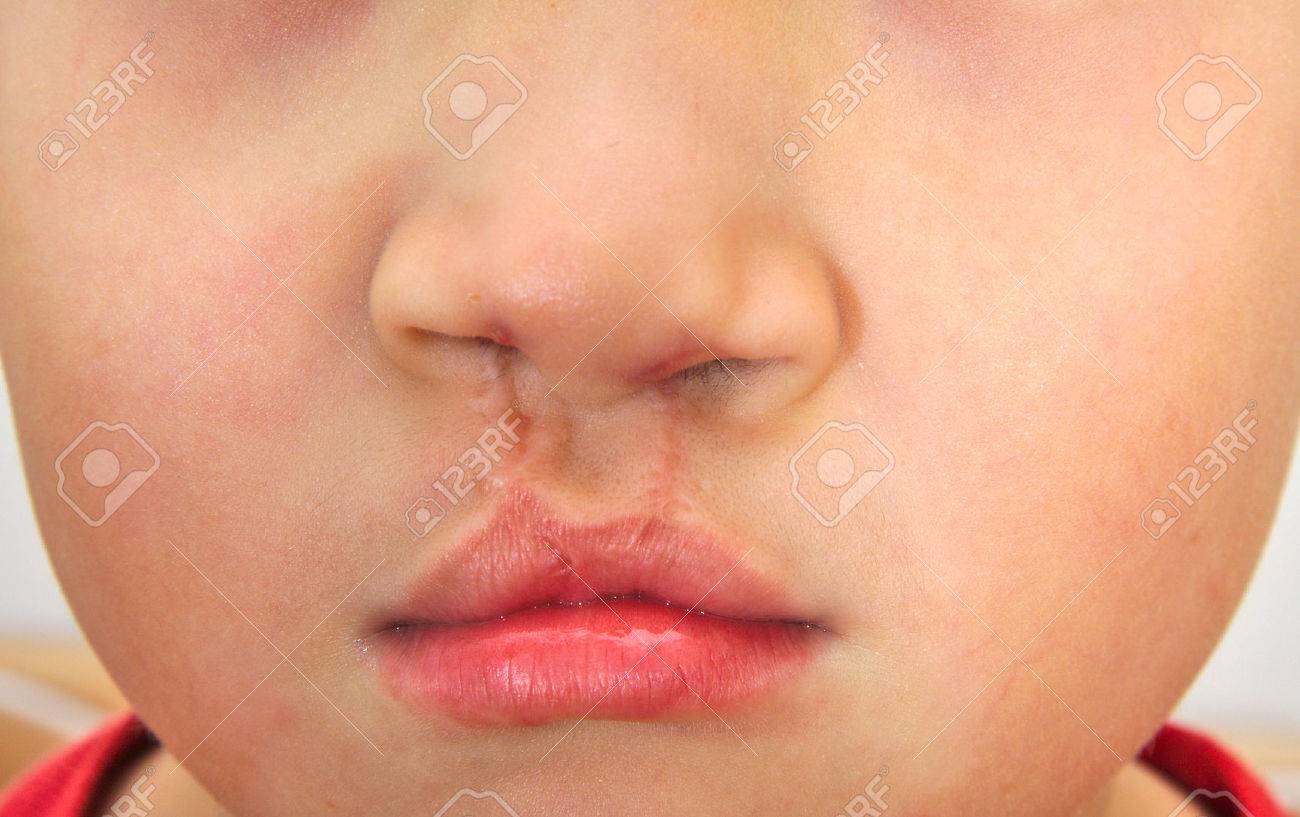 bilateral cleft lip