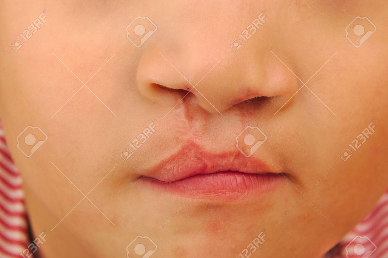 boy showing a bilateral cleft lip repaired stock photo picture and bilateral cleft lip