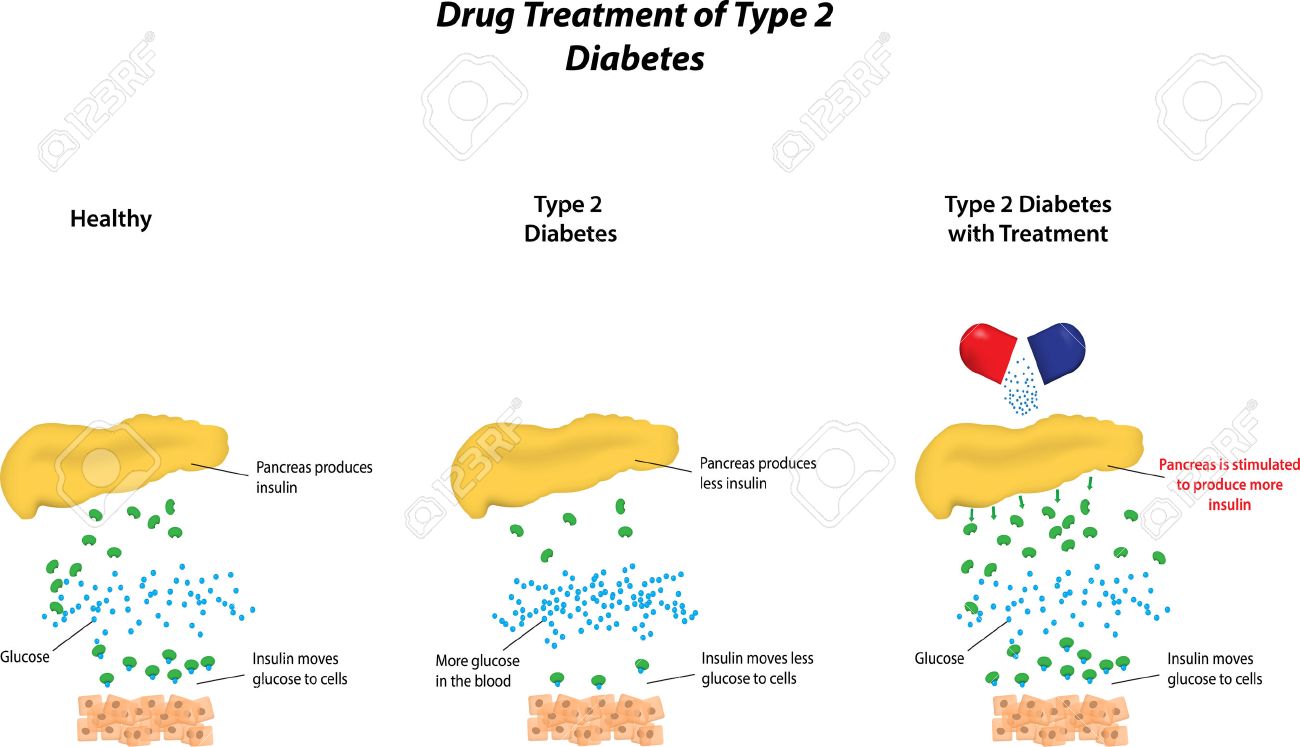 El Tratamiento Farmacologico De La Diabetes Tipo 2 Ilustraciones