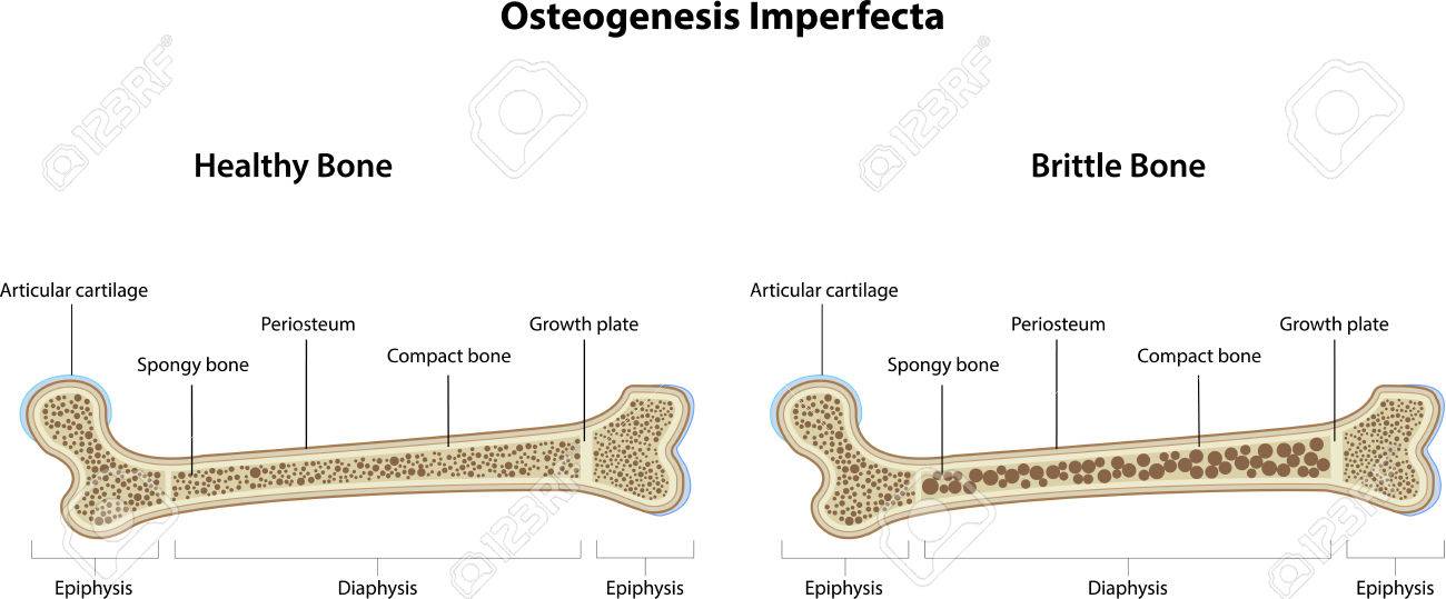 Image result for osteogenesis imperfecta ESPAÃOL