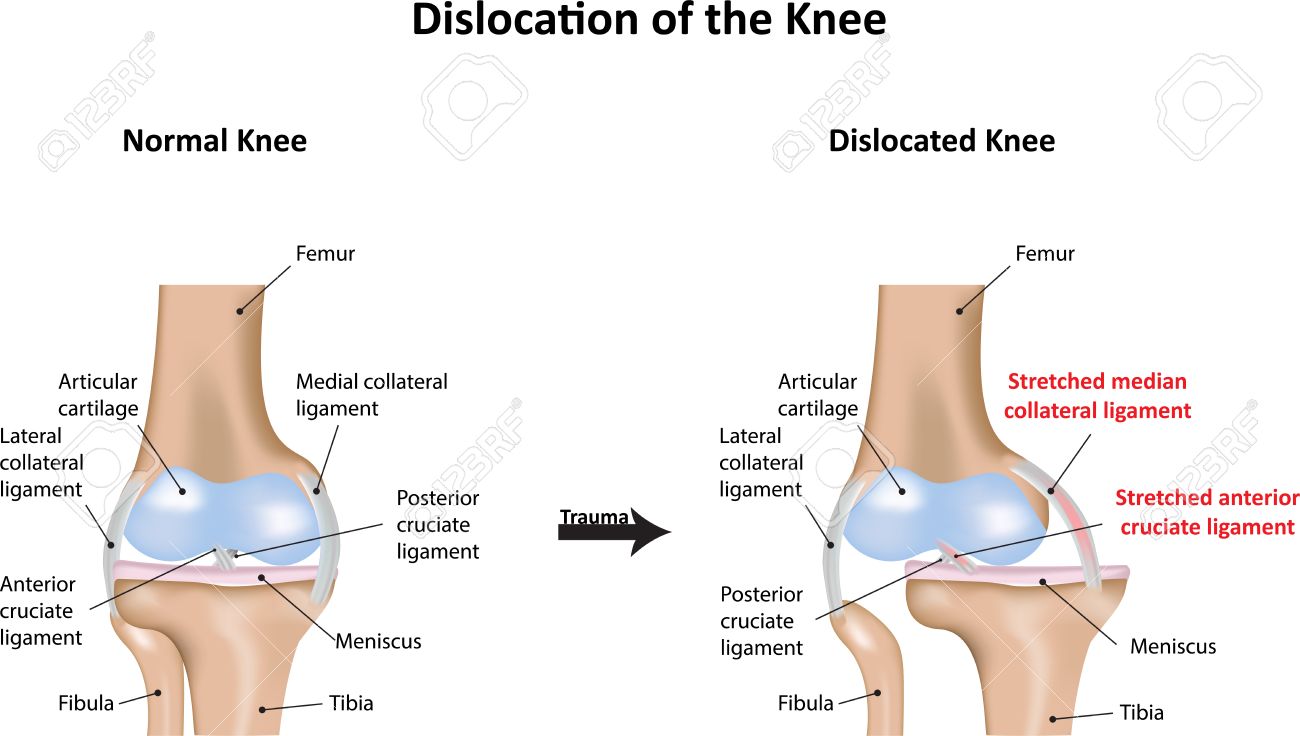 膝関節脱臼 のイラスト素材 ベクタ Image