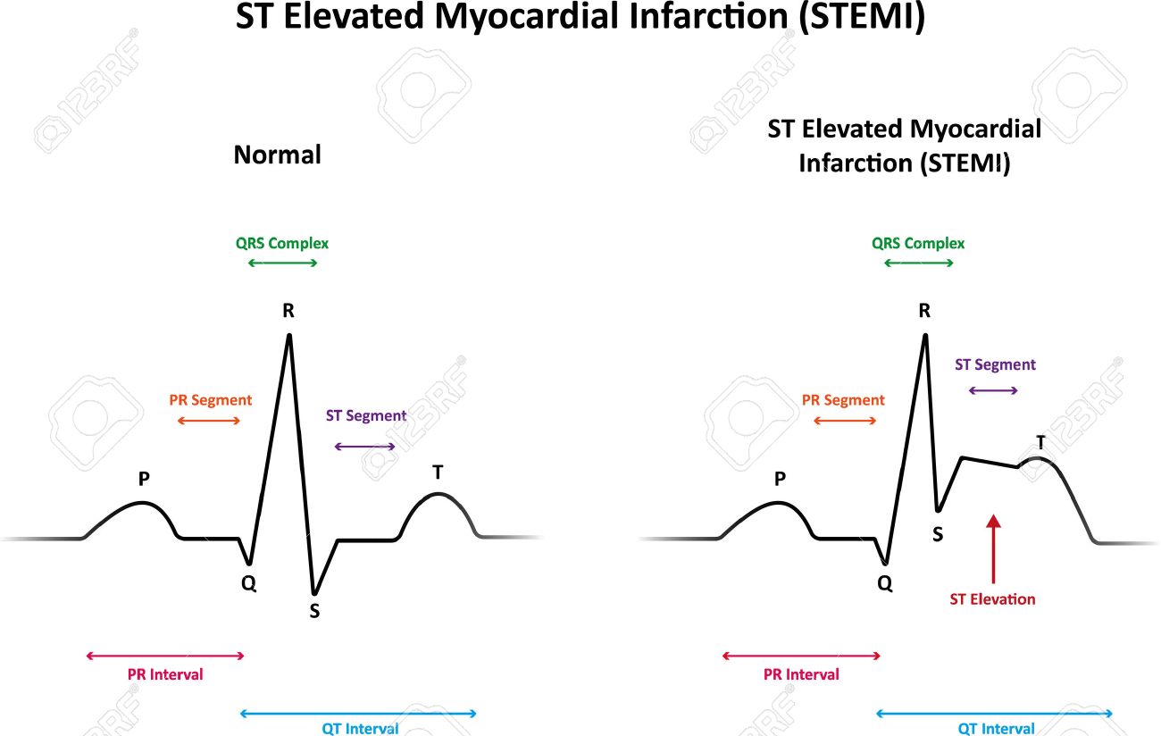 st elevation myocardial infarction
