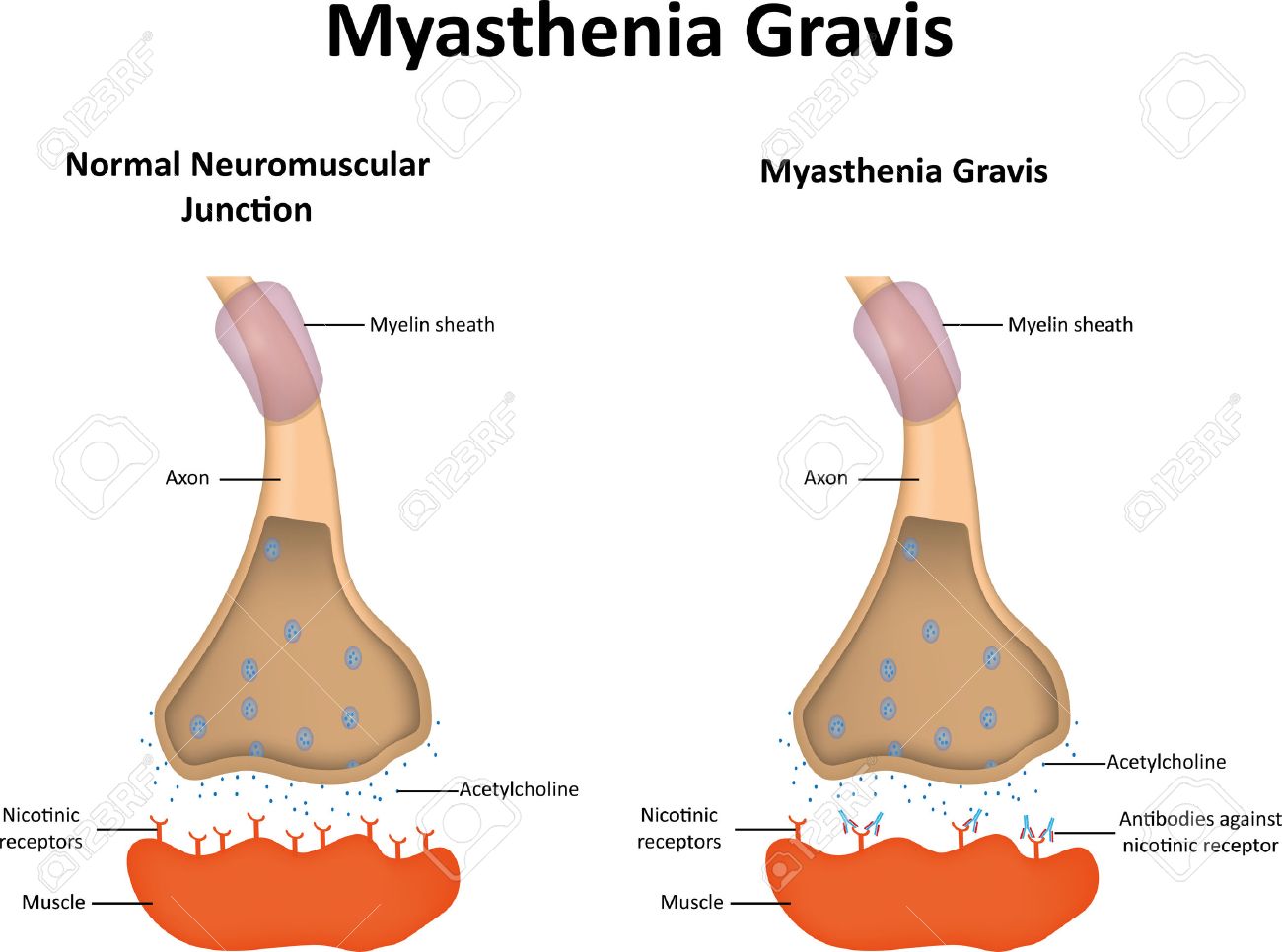 miastenia gravis