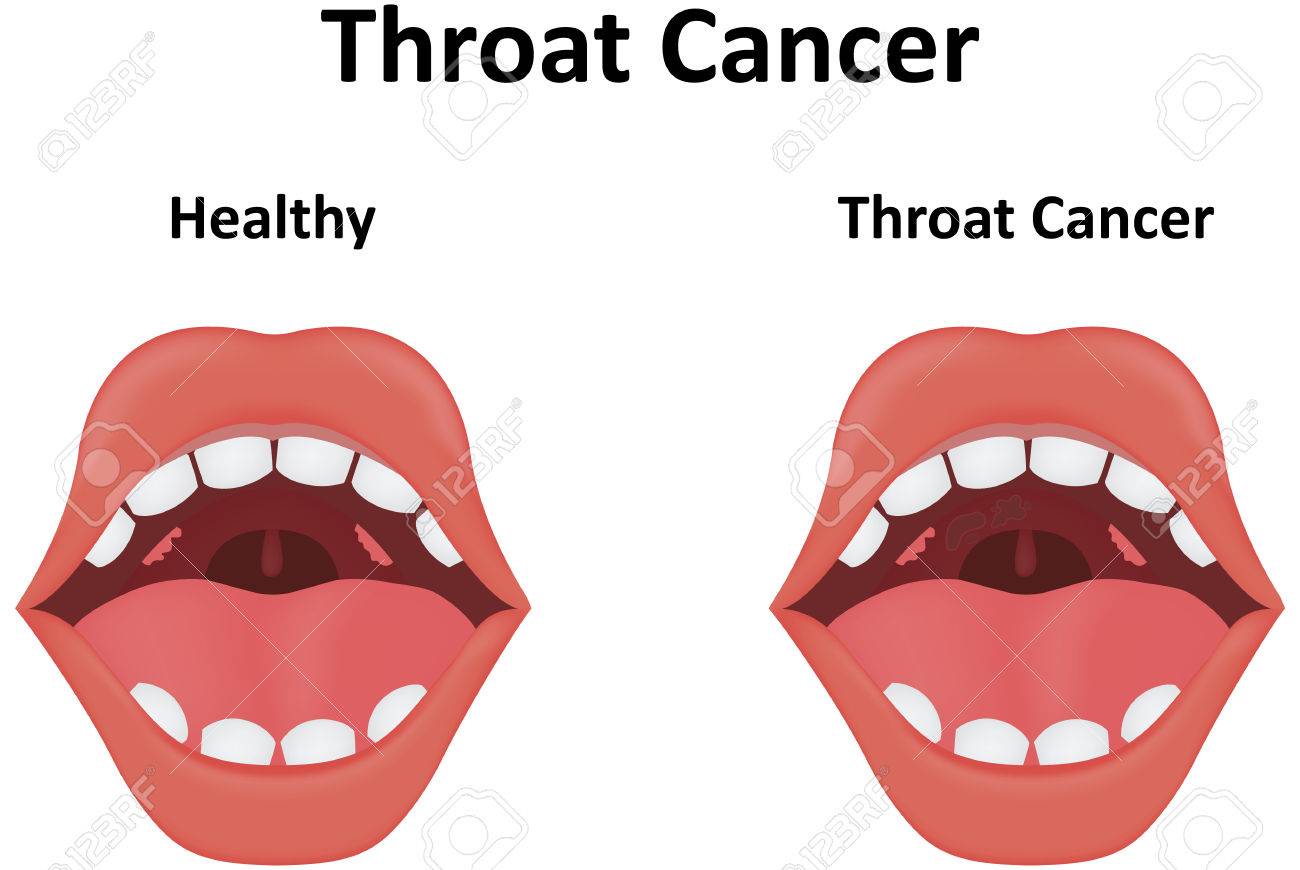 cáncer de garganta ilustraciones vectoriales clip art vectorizado