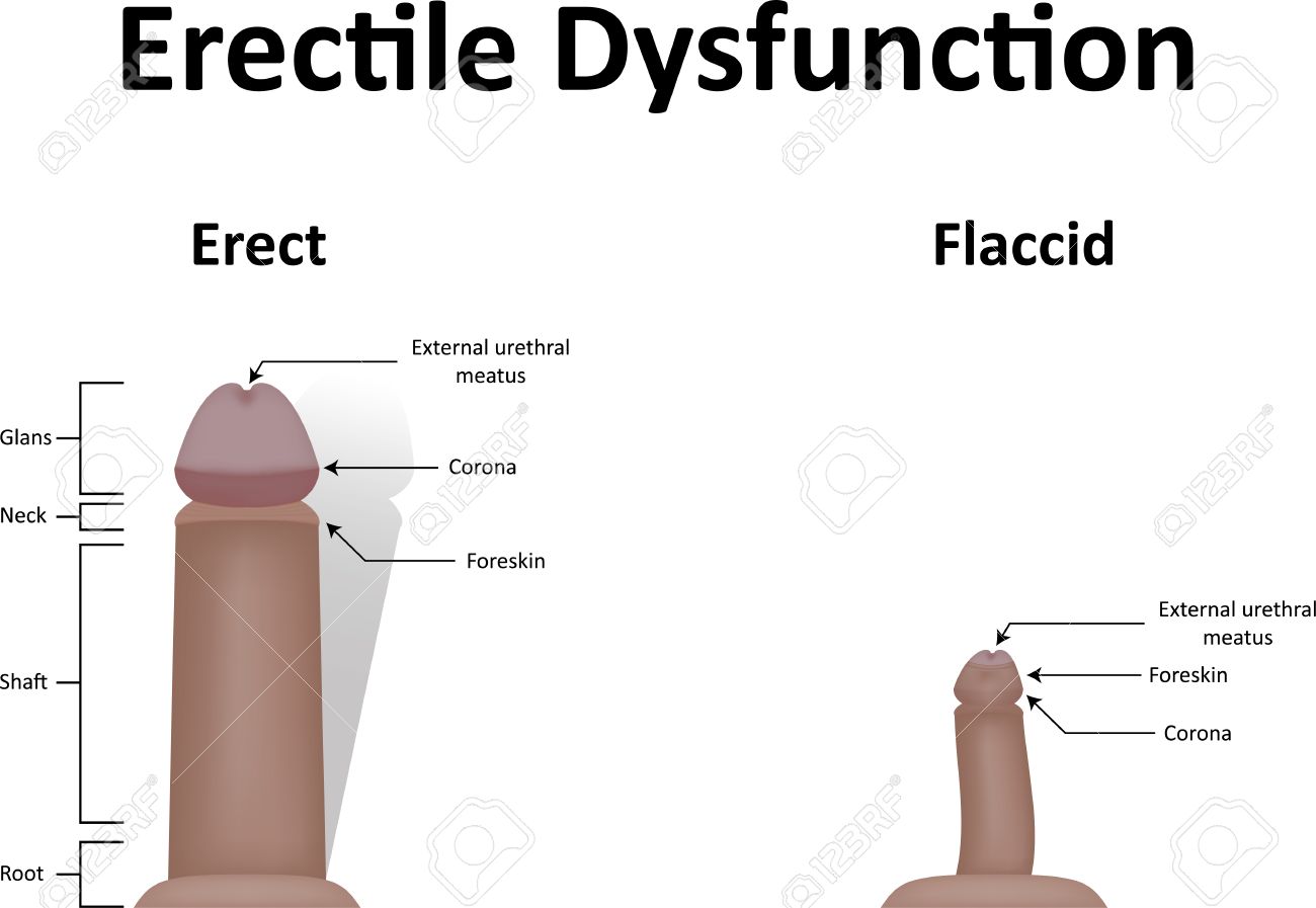 Erectile Dysfunction - 44292675.