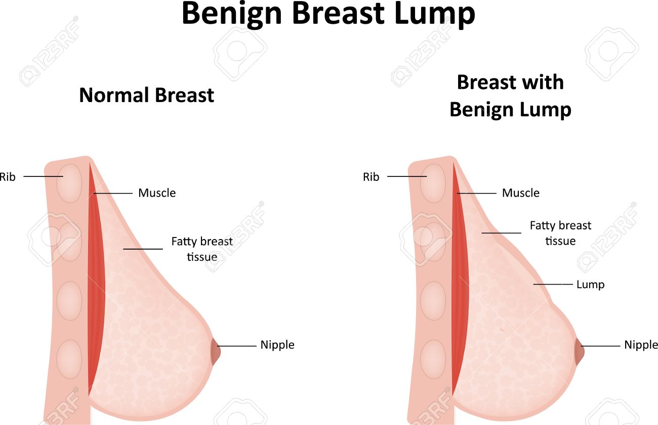 breast cyst growth Breast cyst growth