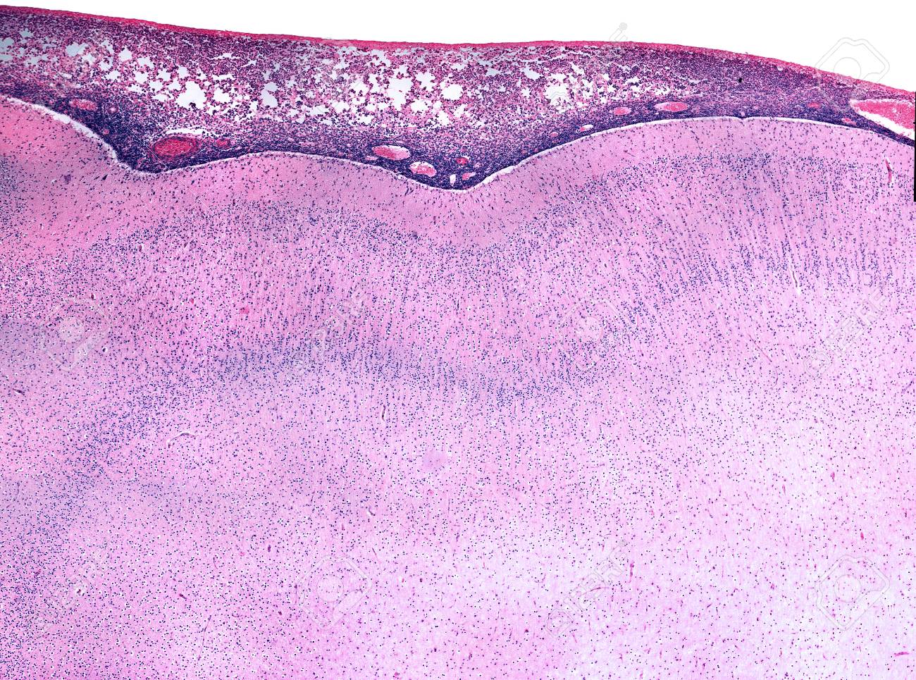 human brain acute meningitis for haemophilus influenzae the haemophilus influenzae