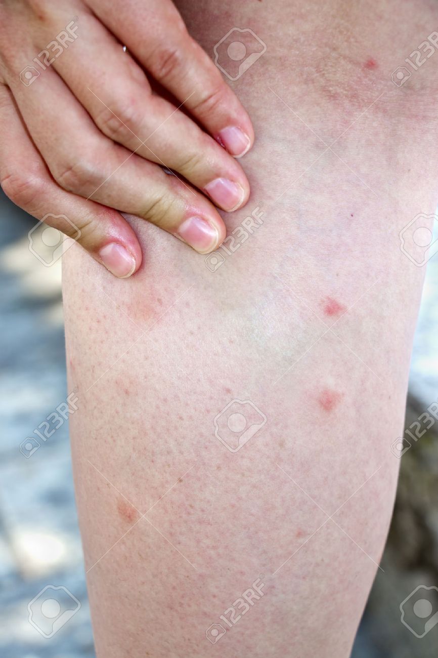 bouton sur les jambes femme bouton sur les jambes femme