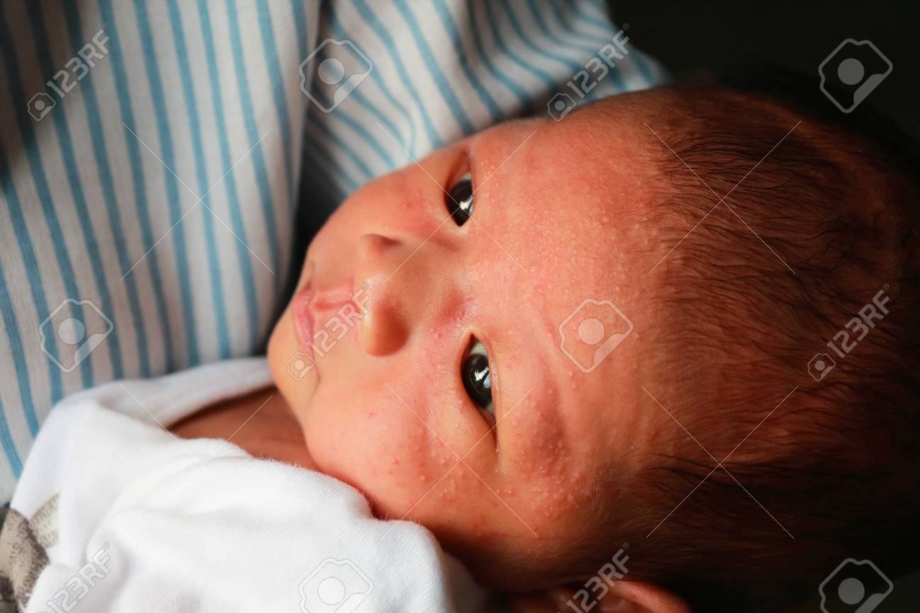 sarpullido en los bebes recien nacidos