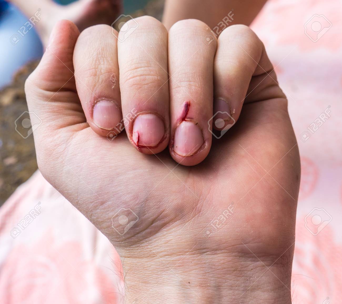 指に傷 強い切り傷 折れた釘 指 の写真素材 画像素材 Image