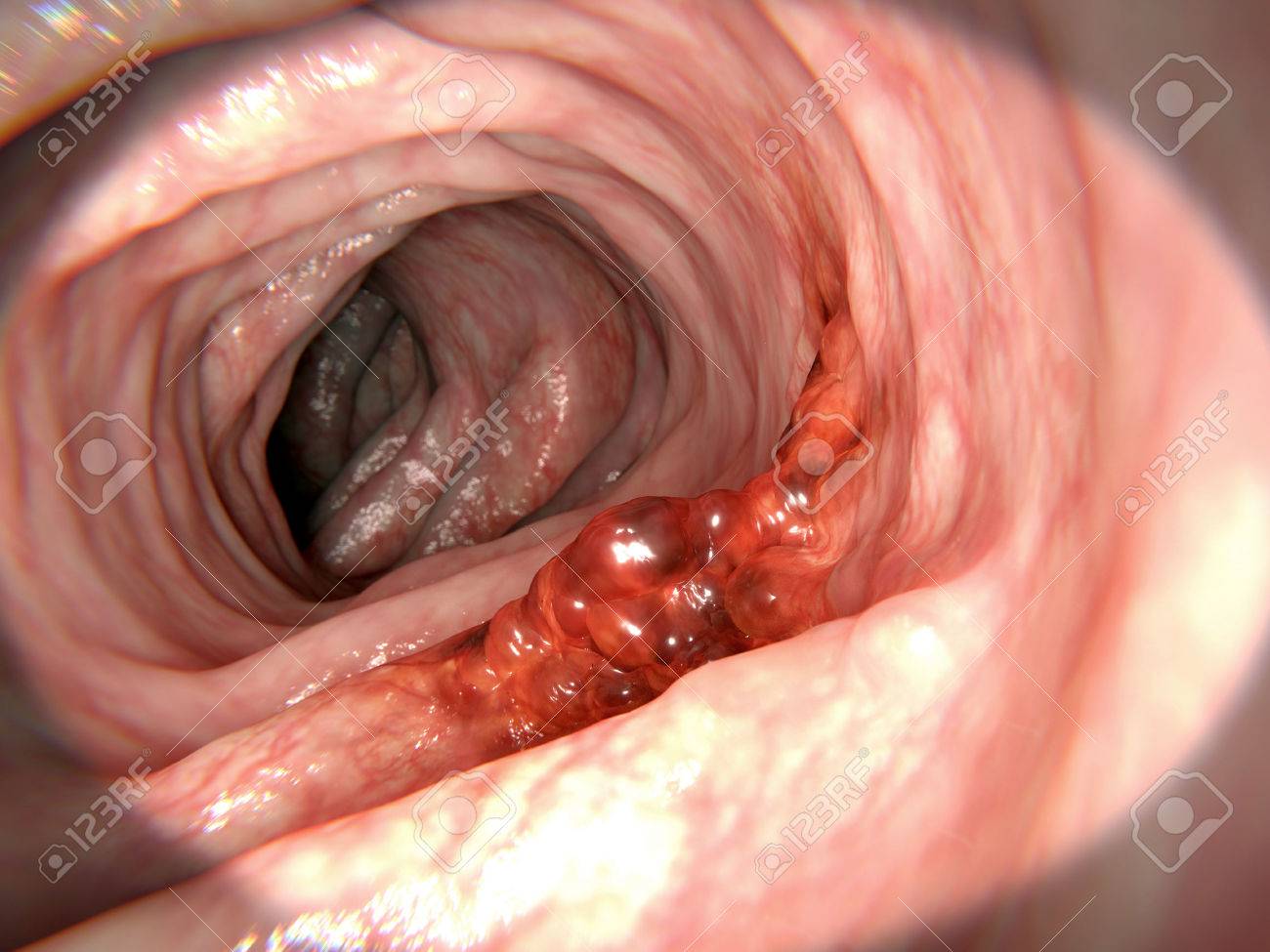 cancer malign colon simptome și tratament de vierme de tenă