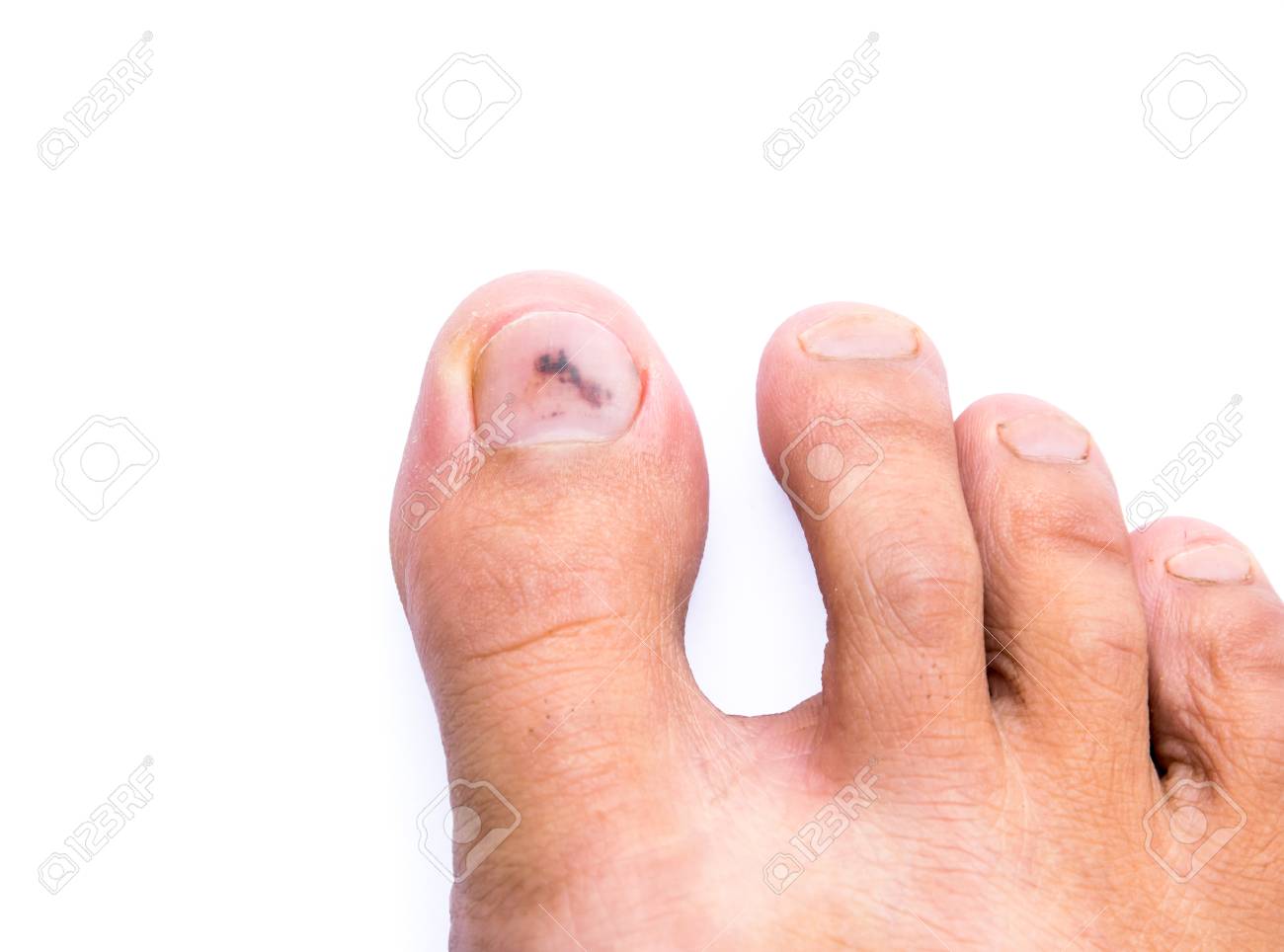 白い背景につま先の爪に打撲傷 アジアの男性の足 の写真素材 画像素材 Image
