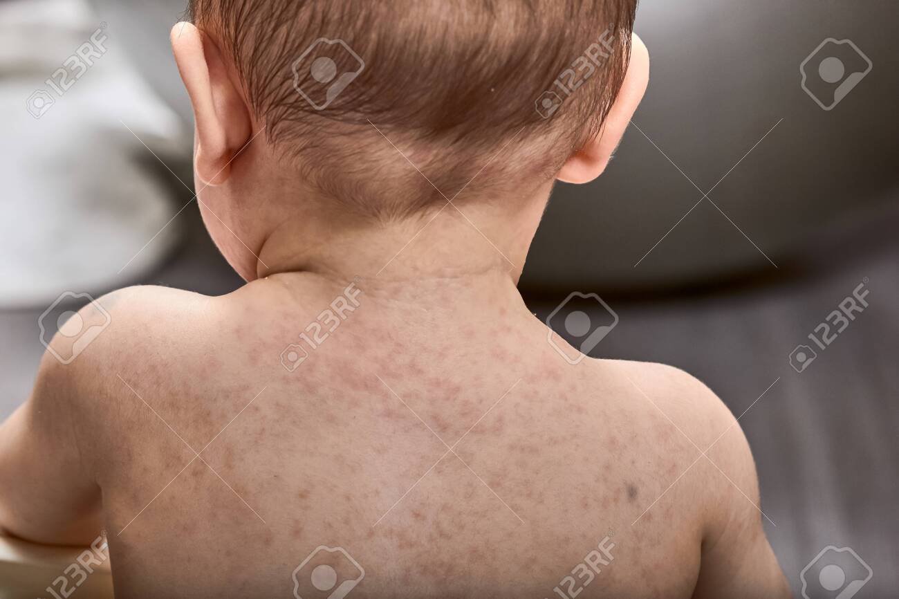 Roseola Rash A Viral Rash On The Skin Of A Child Stock Photo Picture And Royalty Free Image Image