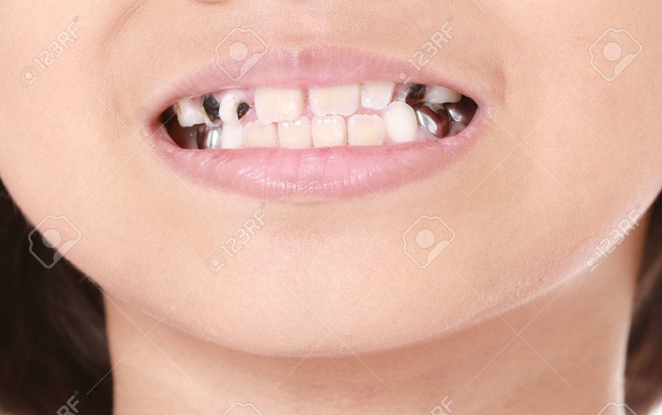 Child Try To Smile With Decay Teeth Stock Photo Picture And Royalty Free Image Image
