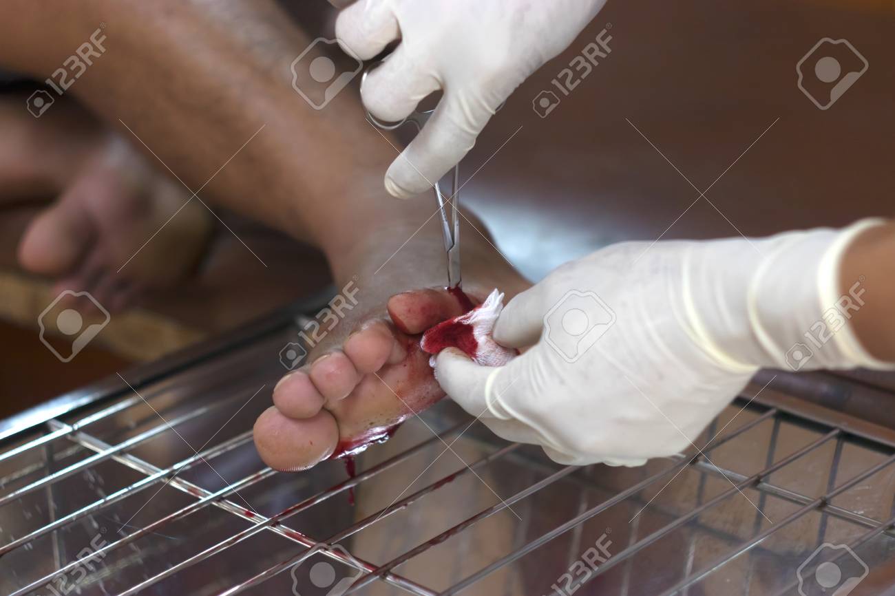 Immagini Stock Ferita Un Piede Scorre Sangue E Rosso Tagliato Su Una Tel Pelle Ferita Di Copula Per Tagliare Le Vene Dolore Professionale Image 92673288